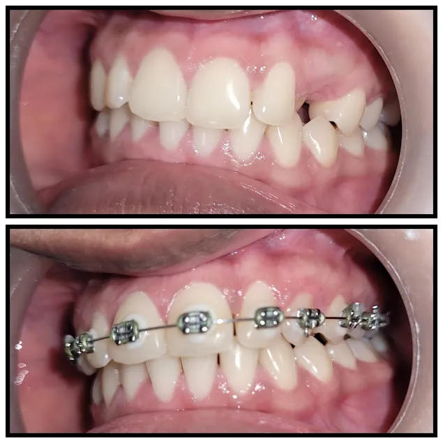 Before and after: Braces Crossbite Canine Alignment
