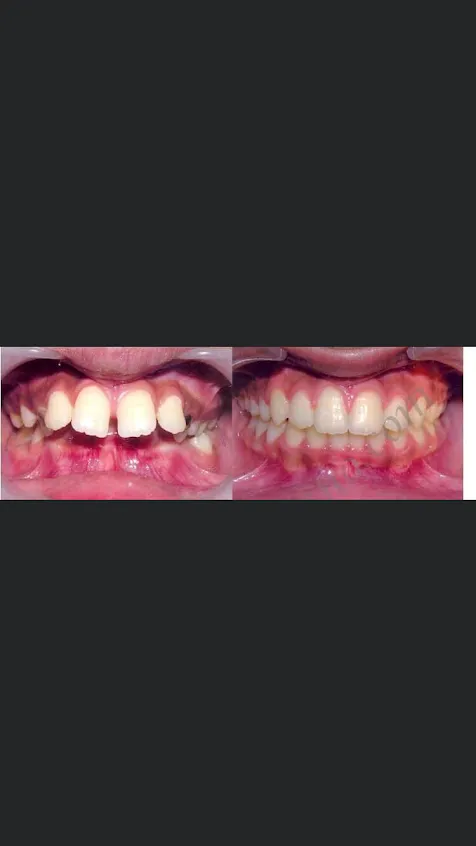 Before and after: Braces Deep Bite Alignment