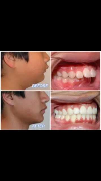 Before and after: Braces Overbite Profile Correction