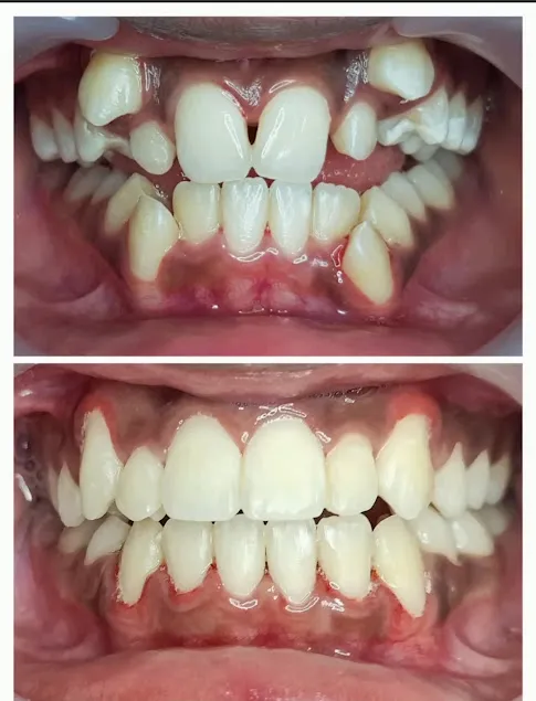 Before and after: Braces Severe Teeth Crowding