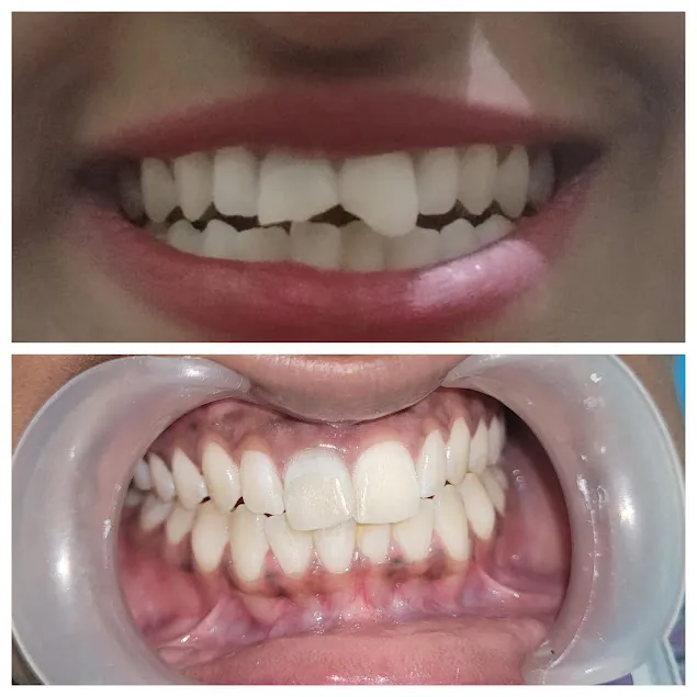 Before and after: Broken Front Tooth Composite Repair