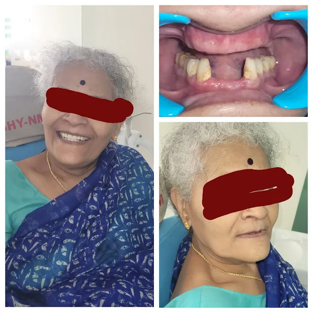Before and after: Full Mouth Complete Dentures Senior