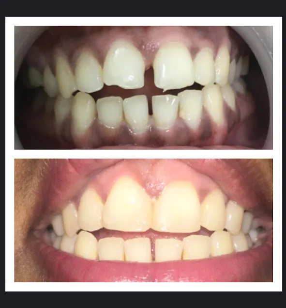 Before and after: Gap Closure Diastema Composite Bonding 1