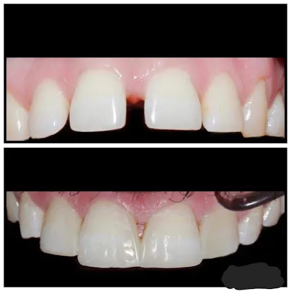 Before and after: Gap Closure Diastema Composite Bonding 2