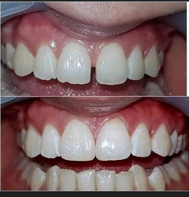 Before and after: Gap Closure Diastema Composite Bonding 3