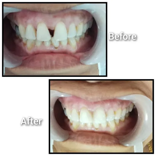 Before and after: Gap Closure Diastema Labeled