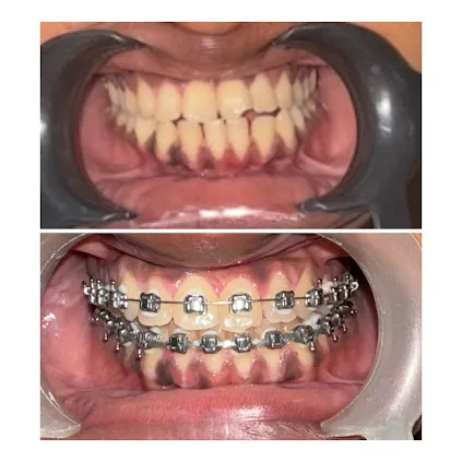 Before and after: Metal Braces Installation