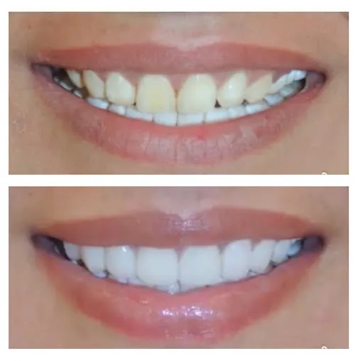 Before and after: Smile Makeover Dental Veneers