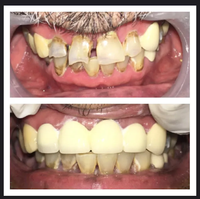 Before and after: Worn Teeth Ceramic Crowns Bridge