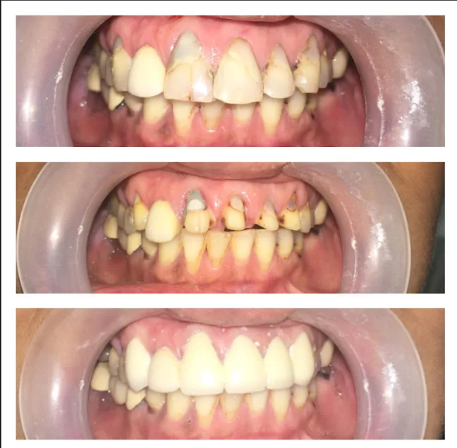 Before During After Anterior Crowns Bridge Rehab