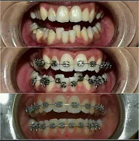 Before During After Lower Crowding Metal Braces