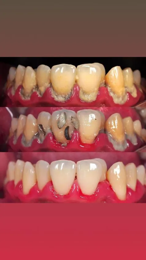 Before During After Teeth Scaling Calculus Removal