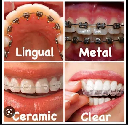 Braces Types Lingual Metal Ceramic Clear